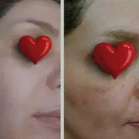 کرم معجزه صد در صد تضمینی با 10سال سابقه کار|آرایشی، بهداشتی، درمانی|خرمشهر, |دیوار