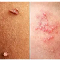 زگیل و تبخال تناسلی رو به طور قطعی از بین ببر