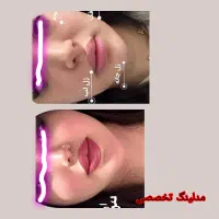 ساکش غبغب تزریق .باسن.شکم|خدمات آرایشگری و زیبایی|کرمانشاه, |دیوار