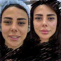 بوتاکس پیشانی و خط اخم  رایگان شد روز یکشنبه