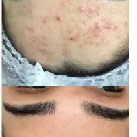 پاکسازی کربن تراپی فیشیال مزونیدلینگ آقا و خانم