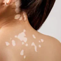 درمان انواع بیماریهای پوستی|آرایشی، بهداشتی، درمانی|شاهرود (اردبیل), |دیوار