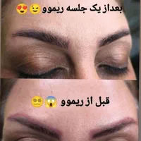 ریموو تتو با اشانتیون  در کلینیک زیبایی|خدمات آرایشگری و زیبایی|تهران, تهرانپارس غربی|دیوار