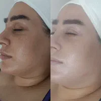 فیشیال پوست با دستگاه تخصصی و برند خارجی ۲۰۰