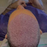 کاشت مو ی پر تراکم|خدمات آرایشگری و زیبایی|ساری, |دیوار