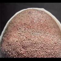 کاشت‌مو با حجم بالا با بهترین قیمت تراکم بالا