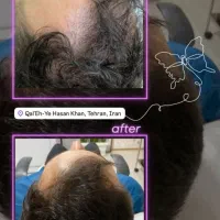 لیزر موهای زائد به مدت محدود فول ۴۹۰|خدمات آرایشگری و زیبایی|ارومیه, |دیوار