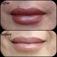 بوتاکس و ژل و لیزر|خدمات آرایشگری و زیبایی|تهران, امیریه|دیوار