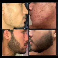 معجزه رویش ریش و سیبیل