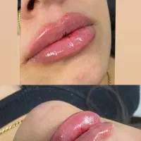 ژل. مزو ژل. جوانساز. بوتاکس