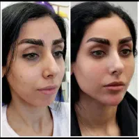 تزریق ژل و بوتاکس و آموزش توسط پزشک