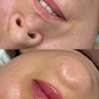 تزریق ژل و بوتاکس