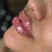 ژل لب زاویه صورت کات گونه