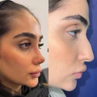 تخفیفات بهاره تزریقات