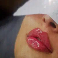 تزریق ژل وبوتاکس