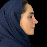 رینوپلاستی (مشاوره و جراحی بینی)