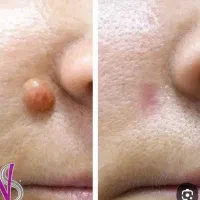 برداشتن خال ومنگوله های گوشتی بدون درد و خونریزی