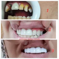 کامپوزیت دندان ژل و بوتاکس پی آرپی و لیفت نخ|خدمات آرایشگری و زیبایی|اهواز, نادری|دیوار