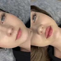 ژل و فیلر با قیمت ویژه