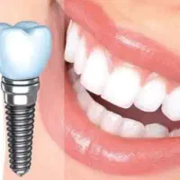 خدمات دندانپزشکی / ایمپلنت/ تعرفه دولتی / ضمانتی|خدمات آرایشگری و زیبایی|کرج, گلشهر|دیوار