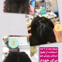 قطع ریزش مو فقط در یک ماه کاملا تضمینی