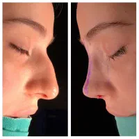 جراحی بینی فقط با پزشک متخصص گوش و حلق و بینی