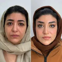 جشنواره ۵۰ درصدی ژل و بوتاکس