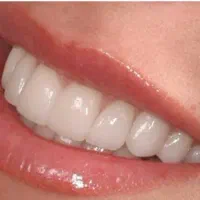 ساخت دندان مصنوعی در لردگان با بهترین کیفیت