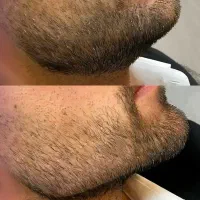 جشنواره تزریق بوتاکس و ژل فیلر چانه گونه زاویه لب|خدمات آرایشگری و زیبایی|فردیس, فردیس|دیوار