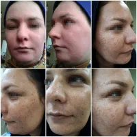 لیزرco2تک جلسه ای،تزریق چربی، دیگر خدمات زیبایی|خدمات آرایشگری و زیبایی|دهدشت, |دیوار