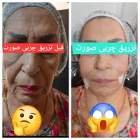 مرکز تزریق چربی صورت ،ژل ،بوتاکس.prp