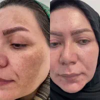 درمان لک کک و مک ملاسما تیرگی وایتنینگ متخصص‌پوست