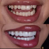 مدل کامپوزیت زیبایی توسط دندانپزشک