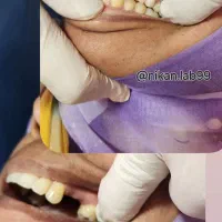 دندانسازی دندان مصنوعی تحویل ۲روزه باضمانت|خدمات آرایشگری و زیبایی|اصفهان, کشاورزی|دیوار