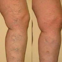 درمان واریس های سطحی وعمقی فقط دریک جلسه