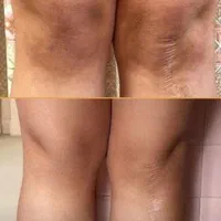 جوانسازی و لایه برداری پوست توسط پزشک|خدمات آرایشگری و زیبایی|زنجان, |دیوار