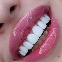 کامپوزیت دندان با اقساط بدون بهره