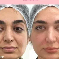 هایفوتراپی صورت غبغب شکم وتنگی واژینال