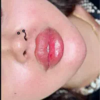 تخفیف تزریق ژل و بوتاکس ویژه