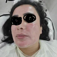 تکنیک مزووایت(روشن کننده پوست) کرمپودر دائم|خدمات آرایشگری و زیبایی|لاهیجان, انقلاب|دیوار
