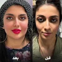 ژل لب بوتاکس فیلر مزو ژل یانگ فیس پی ارپی نخ لیفت|خدمات آرایشگری و زیبایی|مشهد, احمدآباد|دیوار