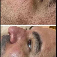 جشنواره پاک کردن تتو با لیزر و کربن تراپی پوست|خدمات آرایشگری و زیبایی|زنجان, |دیوار