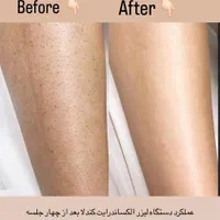 جشنواره لیزر مو زائد بانوان الکس کندلا شاتی اصل