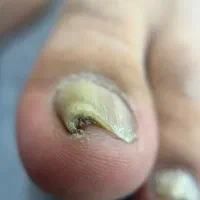 فرورفتگی ناخن توگوشت