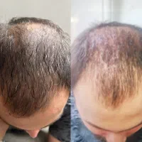 نیازمند مدل جهت فیلر لب|خدمات آرایشگری و زیبایی|تهران, قیطریه|دیوار