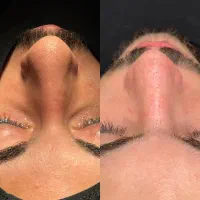 جراحی بینی بدون تامپون|خدمات آرایشگری و زیبایی|تهران, باشگاه نفت|دیوار