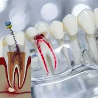 عصب کشی دندان های جلو