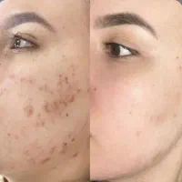 جوانسازی و پاکسازی عمیق پوست فشیال و پلاژن تراپی