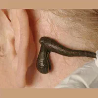 حجامت بادکش امبدینگ طب سوزنی زگیل تناسلی hpv|خدمات آرایشگری و زیبایی|اصفهان, جاوان|دیوار