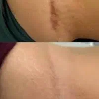 پاک کردن رد عمل.ابدو.لیپو.خودزنی.ترک شکم وبدن|خدمات آرایشگری و زیبایی|مشهد, هنرستان|دیوار